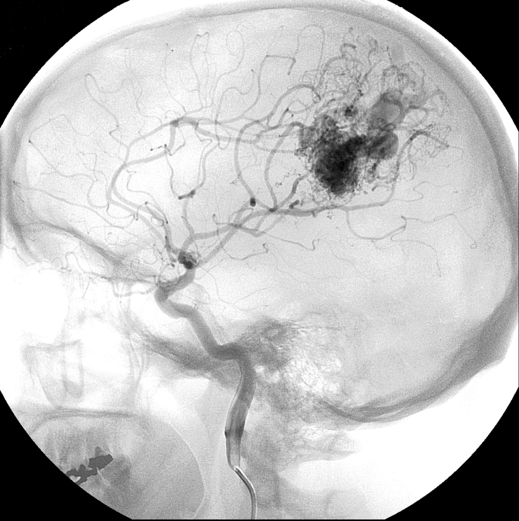Angiografía cerebral en pantalla
